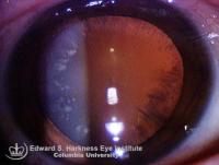 Coronary Cataract. Slitlamp and retroillumination view of bilateral coronary cataract demonstrating club-shaped and focal dots opacities distributed radially in the deep cortex.